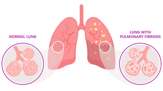 Breathing new hope into pulmonary fibrosis research – Bristol Myers Squibb