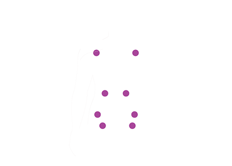 Multiple myeloma
