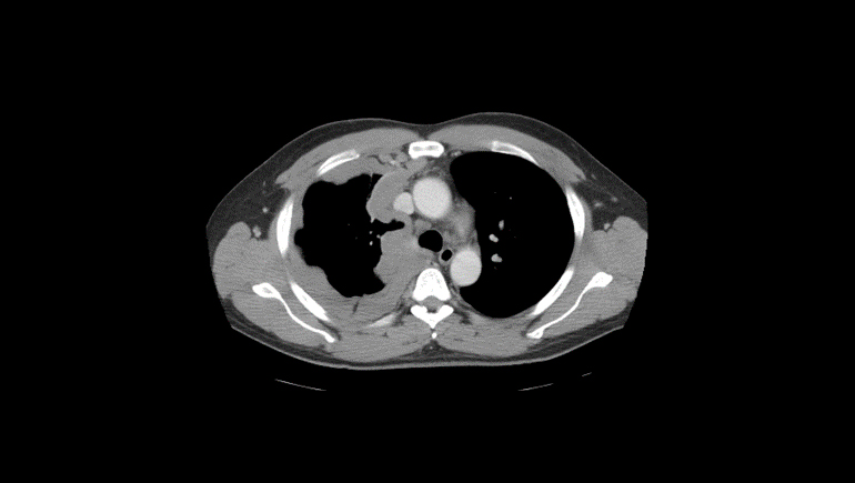 Example scan of a patient presenting with mesothelioma